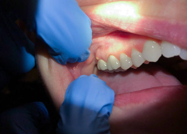 Best Dentist for Tooth Abscess  in Lincoln, CA