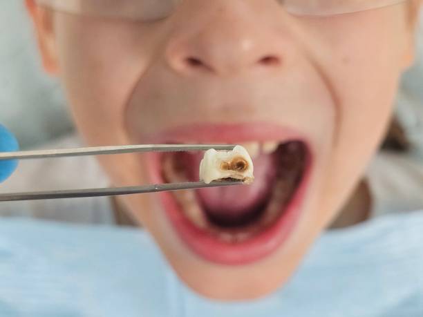 Best Cracked Tooth Emergency Dentist  in Lincoln, CA